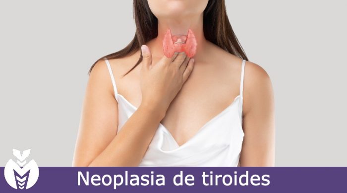 Neoplasia de tiroides Dra Monserrath Acosta Neoplasia de tiroides Dra Monserrath Acosta