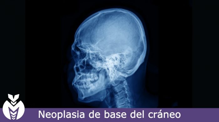 Neoplasia de base de cráneo Dra Monserrath Acosta Neoplasia de base de cráneo Dra Monserrath Acosta