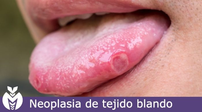 Neoplasia de tejidos blandos Dra Monserrath Acosta Neoplasia de tejidos blandos Dra Monserrath Acosta