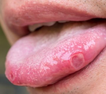 Neoplasia de tejidos blandos Dra Monserrath Acosta